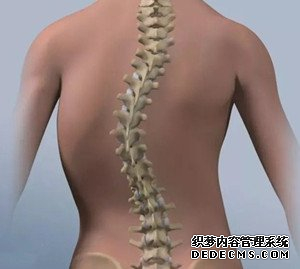 脊柱側(cè)彎要及時(shí)干預(yù)