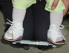 兒童足內(nèi)八字，外八字矯正