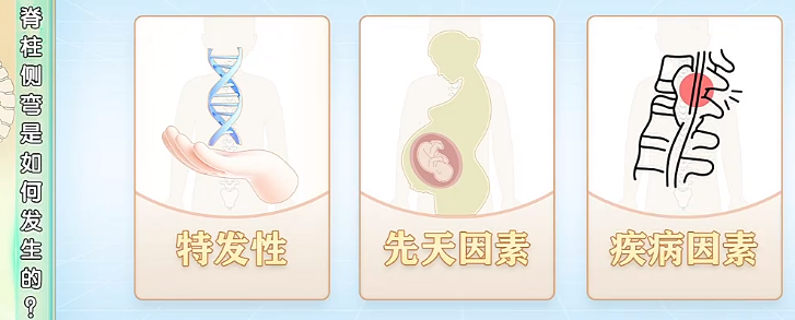 脊柱側(cè)彎是如何發(fā)生的