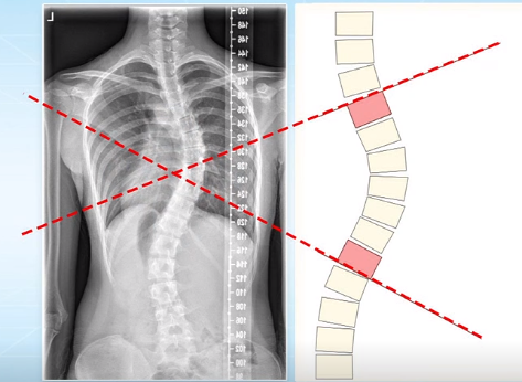脊柱側彎的角度測量