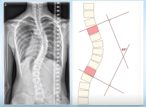 脊柱側彎的角度測量