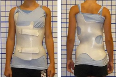 脊柱側(cè)彎的呼吸加支具