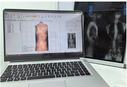 科學(xué)面對脊柱側(cè)彎