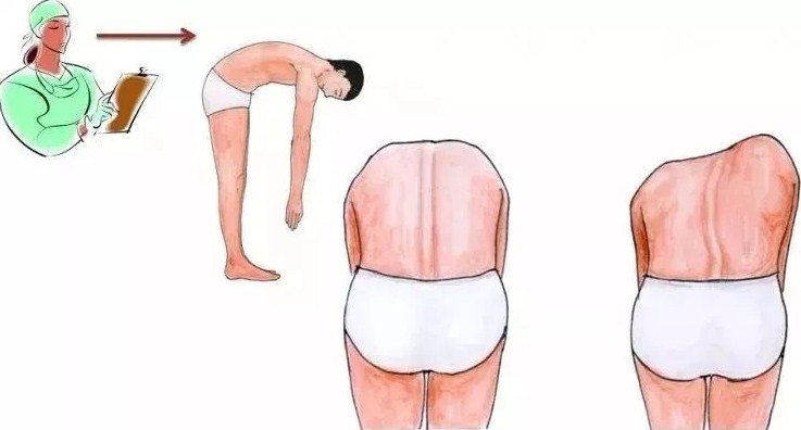 脊柱側彎早發(fā)現(xiàn)，早治療