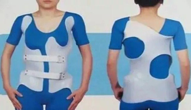 脊柱側彎早發(fā)現(xiàn)，早治療