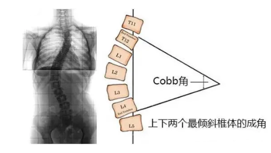脊柱側(cè)彎角度怎么測(cè)量？