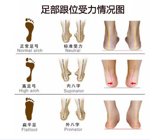 扁平足和脊柱側(cè)彎之間有關(guān)聯(lián)嗎？