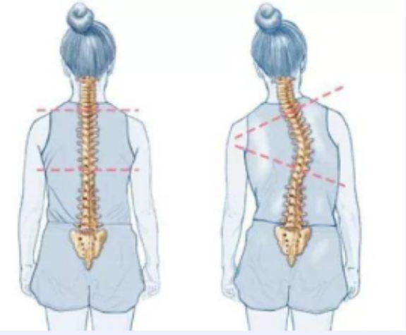 扁平足和脊柱側(cè)彎之間有關(guān)聯(lián)嗎？