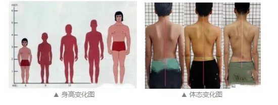 脊柱側(cè)彎支具