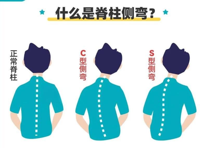 脊柱側彎與自查