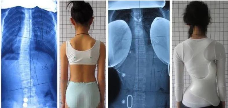 佩戴脊柱側(cè)彎矯形器后的運(yùn)動(dòng)治療