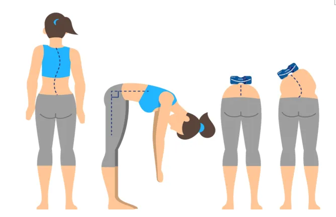 脊柱側(cè)彎支具穿戴3個月要及時復查