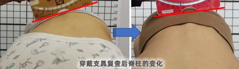 脊柱側(cè)彎支具穿戴3個月要及時復查