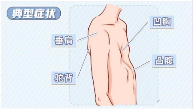 漏斗胸怎么矯正？