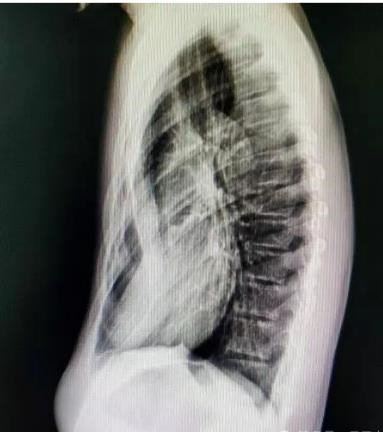 漏斗胸怎么矯正？