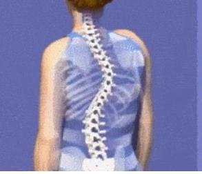 成人脊柱側(cè)彎怎么辦？