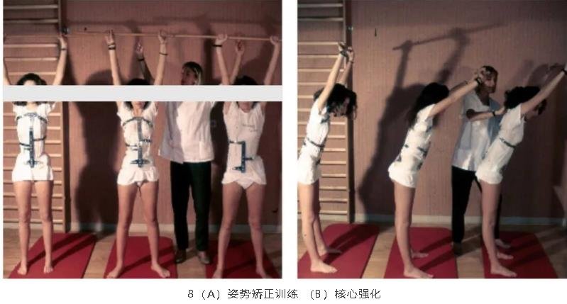 法國里昂的一種脊柱側彎康復辦法